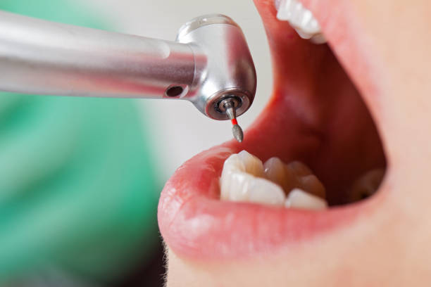 Best Emergency Dentist for Knocked-Out Tooth in Dade City, FL